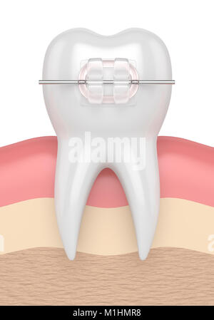 3D render del dente con ceramica chiara tutore di gengive Foto Stock