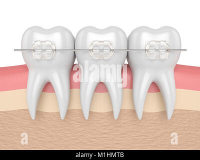 3D render di denti con ceramica chiara bretelle in le gengive Foto Stock