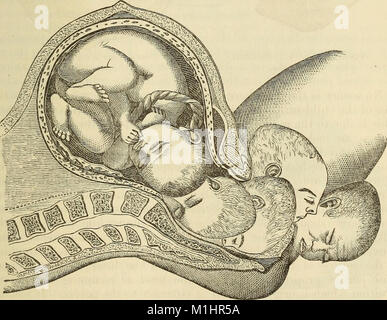 Un sistema di ostetricia, comprese le malattie della gravidanza e stato puerperale (1875) (14743605746) Foto Stock