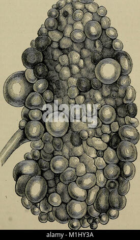 Una pratica Treatise on urinario e malattie renali - compresi i depositi delle vie urinarie (1879) (14758241856) Foto Stock
