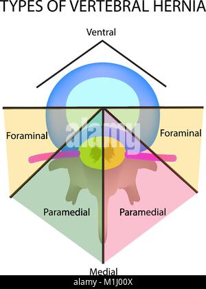 Tipi di ubicazione dell'ernia intervertebrale. Illustrazione Vettoriale su sfondo isolato Illustrazione Vettoriale