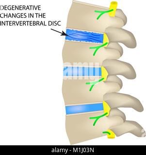 Cambiamenti degenerativi nel disco intervertebrale. Illustrazione Vettoriale su sfondo isolato. Illustrazione Vettoriale