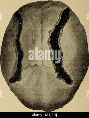 Un trattato sulle malattie del sistema nervoso dei bambini, per i medici e gli studenti (1905) (14598175717) Foto Stock