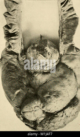 La prassi americana di Chirurgia; un sistema completo di scienza e arte della chirurgia (1906) (14576903940) Foto Stock