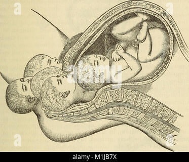 Un sistema di ostetricia, comprese le malattie della gravidanza e stato puerperale (1875) (14580154677) Foto Stock