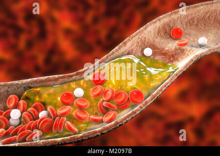 Placche ateromatose all'interno del vaso sanguigno, illustrazione del computer. Un colesterolo ateroma sta causando un restringimento di una arteria (aterosclerosi). Foto Stock