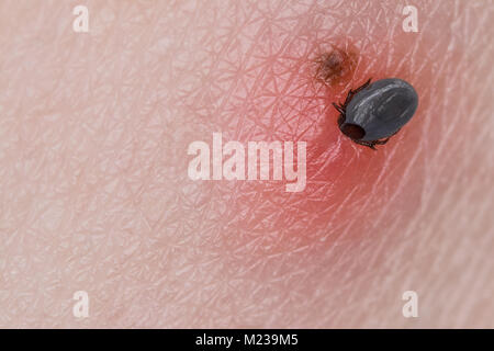 Tick e freckle. Ixodes ricinus. Close-up di piccoli acari parassiti quando succhiare il sangue sulla pelle umana con la birthmark. Encefalite, la malattia di Lyme. Foto Stock