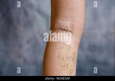 Womans gamba dopo chirurgia dele varici, con visibile suture chirurgiche (punti) e ferite sulla sua gamba. Trattamento curativo, procedimenti estetici, montaggio passante Foto Stock