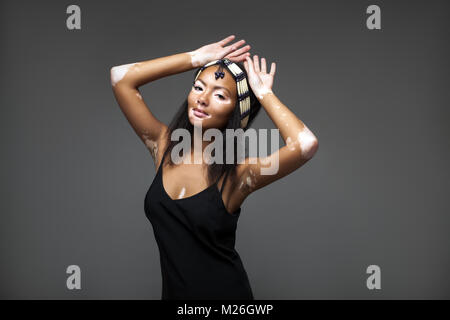 Bella ragazza africana in studio con i problemi della pelle vitiligine riprese in studio Foto Stock