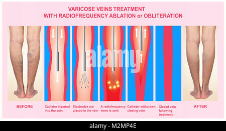 Le vene varicose e il trattamento con ablazione a radiofrequenza Foto Stock