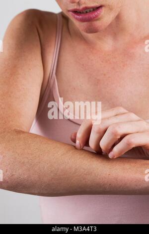 Modello rilasciato. Donna di graffiare itchy braccio. Foto Stock
