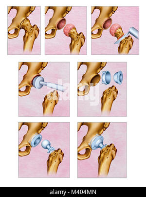 Ilustración sobre el tratamiento quirúrgico por artrosis en la articulación de la cadera. La artrosis de cadera es el desgaste del Cartílago de la tecnica Foto Stock