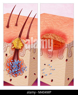 Illustrazione sulle infezioni della pelle Foto Stock