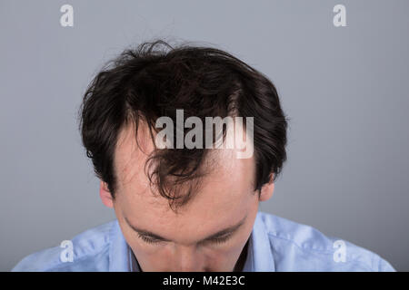 Close-up del capo di un uomo con la perdita dei capelli i sintomi Foto Stock