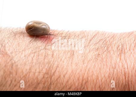 Dettaglio tick - parassita sulla pelle dell'uomo (Rhipicephalus sanguineus) Foto Stock