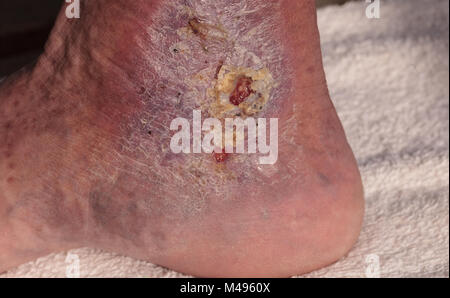 Immagini mediche: infezione cellulite sulla pelle Foto Stock