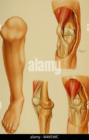 Atlas e epitome di fratture traumatiche e dislocazioni (1902) (14757521726) Foto Stock