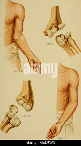 Atlas e epitome di fratture traumatiche e dislocazioni (1902) (14779880832) Foto Stock