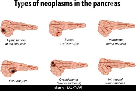 Tipi di neoplasie del pancreas. Infographics. Set. Illustrazione Vettoriale su sfondo isolato. Illustrazione Vettoriale