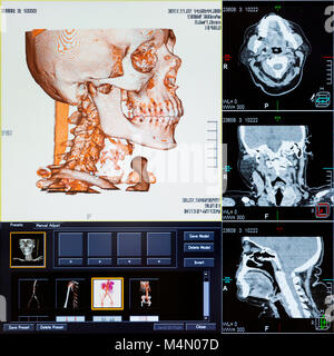 Imaging a risonanza magnetica (MRI) scansione - le scansioni CT della testa umana su un computer ad ultrasuoni monitor. Foto Stock