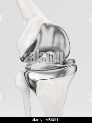 Ginocchio con moderne protesi del ginocchio - 3D Rendering Foto Stock