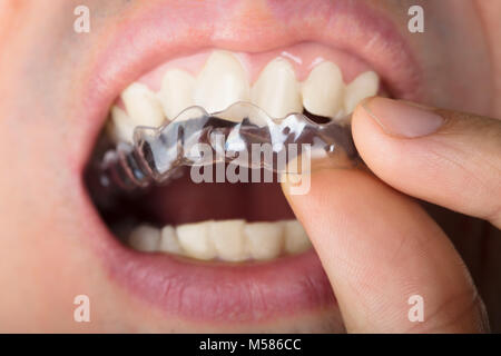 Immagine ritagliata dell uomo di regolazione di allineatori trasparenti in denti Foto Stock