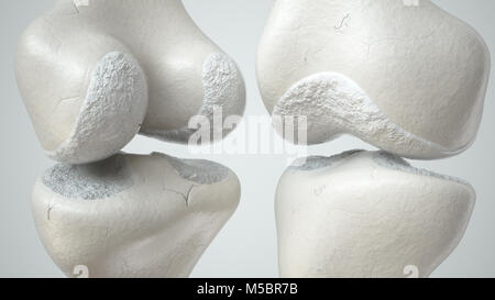 Articolazione del Ginocchio con perdita di cartilagine a causa Arthose, fronte e retro- 3D Rendering Foto Stock