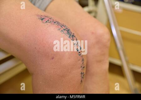 Del ginocchio è una procedura chirurgica che comporta la rimozione molto dolorosa del ginocchio colpite da incidenti o artrite. paziente sul lettino ho Foto Stock