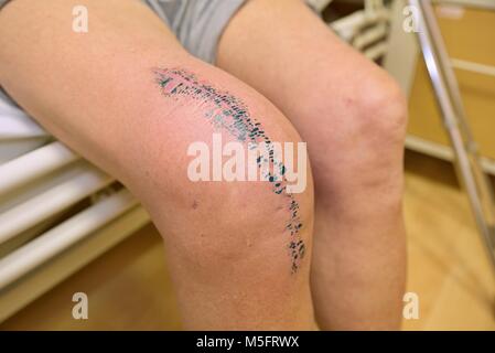 Del ginocchio è una procedura chirurgica che comporta la rimozione molto dolorosa del ginocchio colpite da incidenti o artrite. paziente sul lettino ho Foto Stock