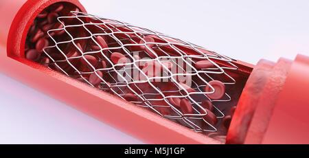 L'angioplastica con posizionamento di stent- 3D rendering Foto Stock
