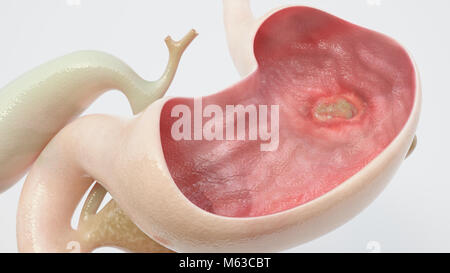 Ulcera di stomaco - alto grado di dettaglio - il rendering 3D Foto Stock