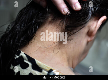 Berlino, Germania. 01 Mar, 2018. 01 marzo 2018, Germania Berlino: pidocchi della testa morsi. Credito: Britta Pedersen/dpa-Zentralbild/ZB/dpa/Alamy Live News Foto Stock