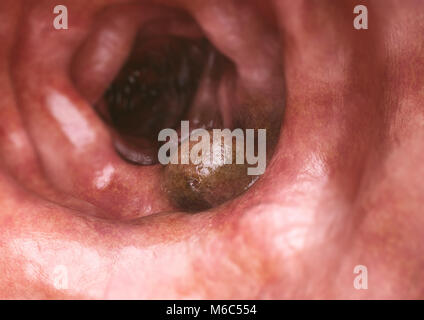 Il cancro del colon closeup - 3D Rendering Foto Stock