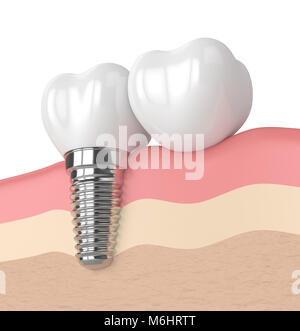 Differenza Tra Corona E Impianto Dentale - Foto 8