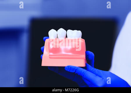 Modello di denti con un impianto dentale nelle mani del medico reale, primo piano. Restauro del dente. Installazione dell'impianto dentale. Protesi dentarie. Foto Stock