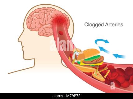 Hamburger e Pizza e patatine fritte blocco di cellule di sangue rosso intasato causa in prima arteria nel cervello. Illustrazione Vettoriale