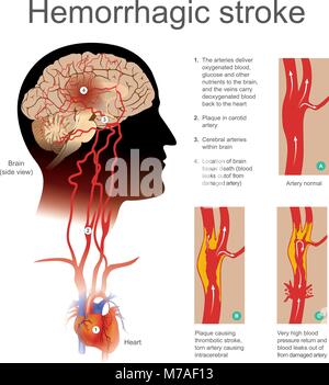 La placca causando ictus trombotico arteria strappata causando intracerebrale. Molto elevato ritorno di sangue e perdite di sangue fuori dalla arteria danneggiata. Illustrazione hu Illustrazione Vettoriale