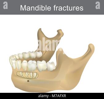 Mandibola fratture è la più grande e più forte e più basso in osso la faccia. Parte del corpo umano. Una infografica anatomia. Illustrazione Vettoriale