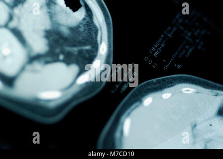 Close-up della MRI scan del cervello umano Foto Stock