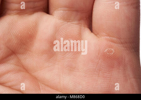 Close-up di blister su umano mano bianca Foto Stock