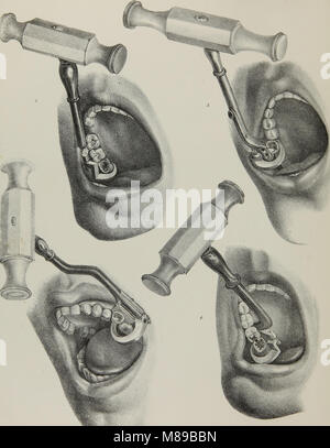 Estrazioni-2;l'anatomia, la fisiologia e la patologia dei denti umani (1844) Foto Stock