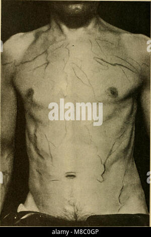 Le malattie del cuore e il sistema arterioso; progettato per essere una presentazione pratica del soggetto per l'uso degli studenti e dei professionisti della medicina (1910) (14582591999) Foto Stock