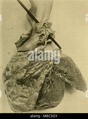 Le malattie del cuore e il sistema arterioso - progettata per essere una presentazione pratica del soggetto per l'uso degli studenti e dei professionisti della medicina (1907) (14753360966) Foto Stock