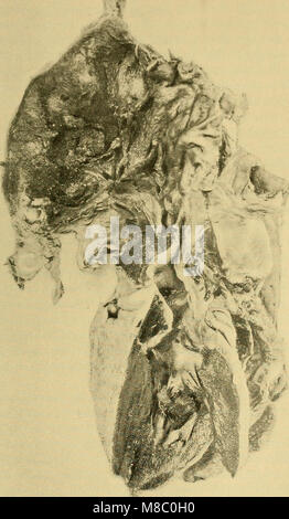 Le malattie del cuore e il sistema arterioso - progettata per essere una presentazione pratica del soggetto per l'uso degli studenti e dei professionisti della medicina (1907) (14753371696) Foto Stock