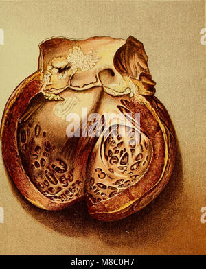 Le malattie del cuore e il sistema arterioso - progettata per essere una presentazione pratica del soggetto per l'uso degli studenti e dei professionisti della medicina (1907) (14796147063) Foto Stock