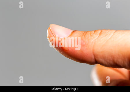 Ulcere della pelle dall'olio casualmente sulla zona del pollice. Foto Stock