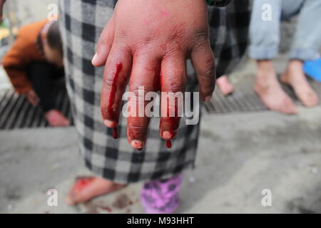 Srinagar, India. Xxi Mar, 2018. Un locale Kashmiris riceve le sanguisughe della terapia in Hazratbal Srinagar la capitale estiva di Indiano Kashmir amministrato. Il Kashmir utilizzare le sanguisughe per trattare le persone che soffrono di prurito e dolore. Le sanguisughe sono spesso utilizzati per guarire malattie, dalla circolazione del sangue alla cura della pelle nella medicina tradizionale nel Kashmir Nowruz che segna il primo giorno di primavera e all'inizio dell'anno nel calendario persiano Credito: Arfath Naseer/ Pacifico premere/Alamy Live News Foto Stock