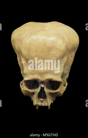 Deformato antico cranio peruviana Foto Stock