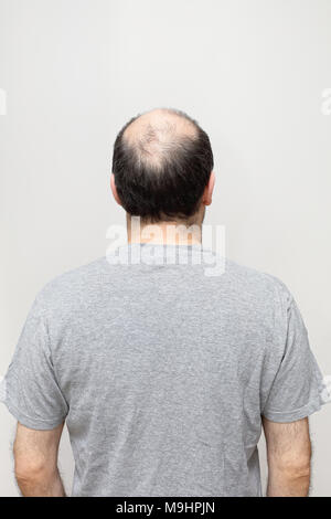 Vista posteriore della perdita dei capelli a mezza età uomo Foto Stock
