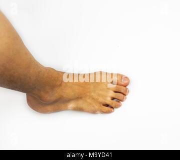 Il piede d'atleta o tinea pedis, sul lato del piede e della gamba su sfondo bianco Foto Stock